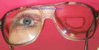 Exposed orbital implant requiring surgical repair