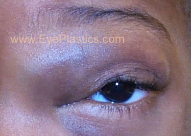Capillary (strawberry) hemangioma involving the eyelid of an infant