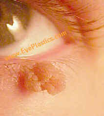 Squamous papilloma mouth - zppp.ro - Squamous papilloma of mouth
